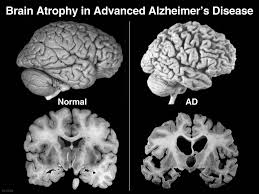 Alzheimer 2